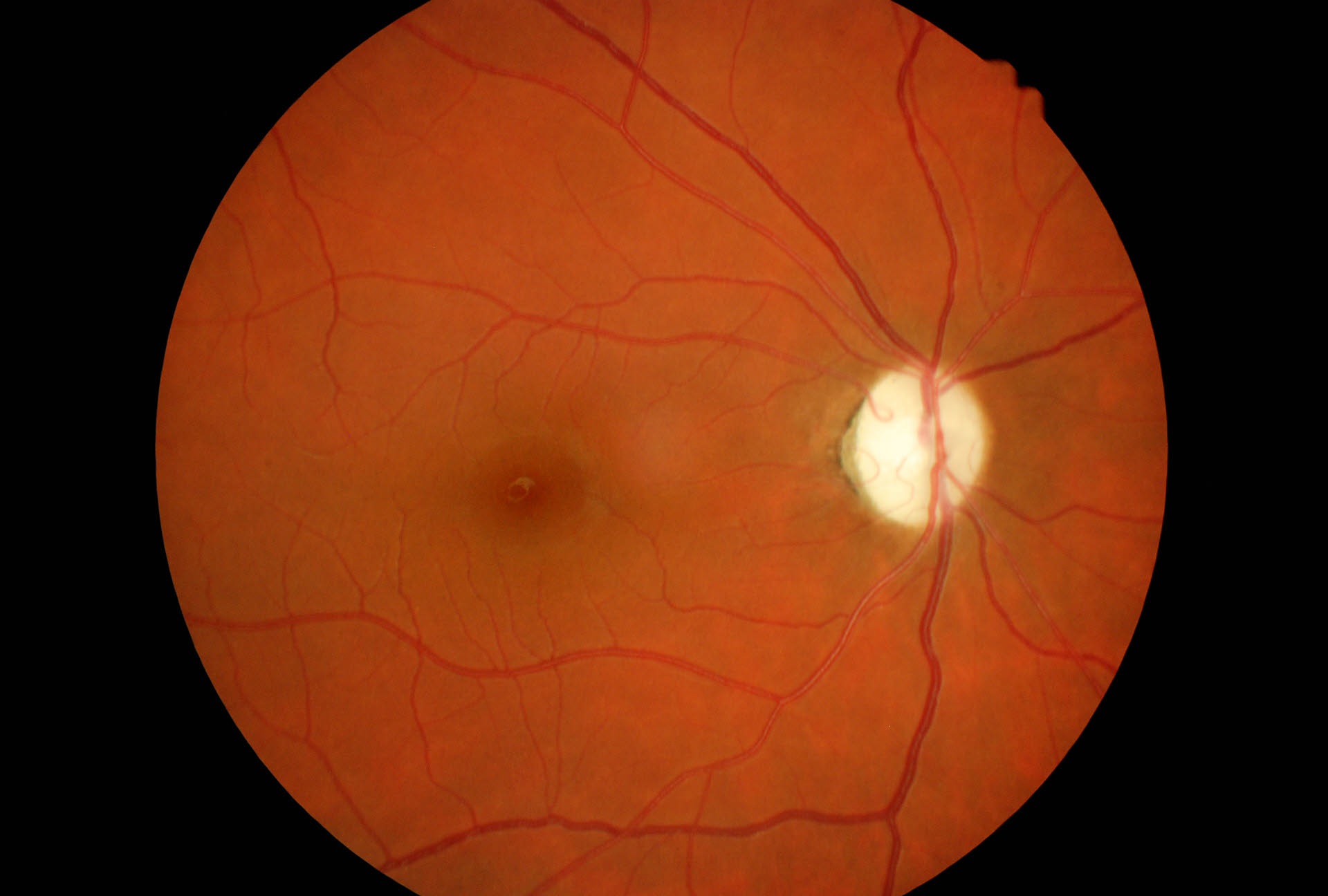 Atrofia Ottica Bilaterale da Sclerosi Multipla